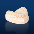 Multilayerd Full Zirconia Dental Restoration